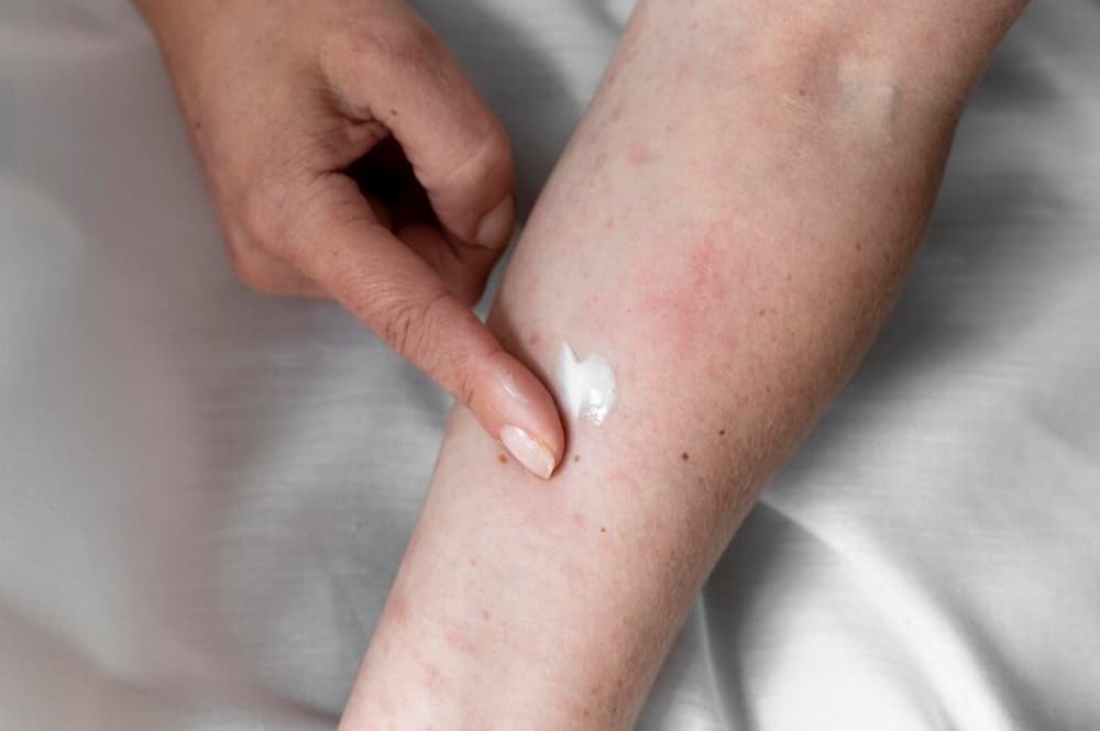 mujer aplicando crema en picadura de aedes japonicus